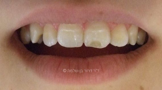 לפני טיפול - פגם מולד בשן קדמית