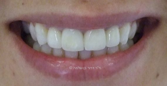 החלפת שתלים קדמיים - אחרי
