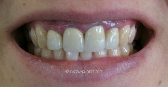 החלפת שתלים קדמיים - לפני
