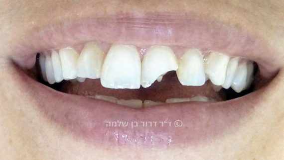 שן קדמית שבורה - לפני טיפול
